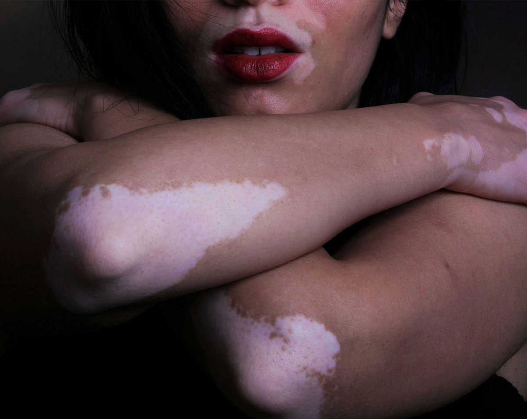 Vitiligo Camouflage